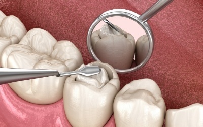 Animated metal free filling shown on new tooth