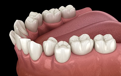 Digital image of crowded teeth