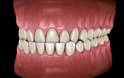 Digital image of an underbite