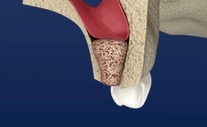 Model of bone grafting procedure for dental implant