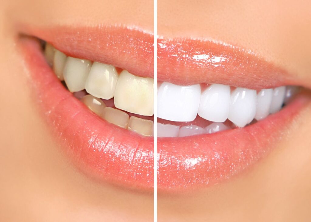 Closeup of woman's smile with sparkly lip gloss half whitened